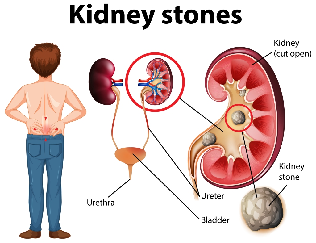 Kidney Stones in Male