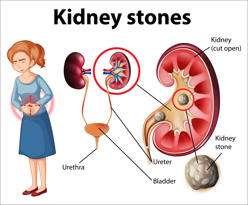 Kidney Stones in Female
